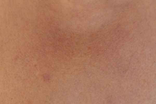 Home Remedies for Hyperpigmentation and Redness