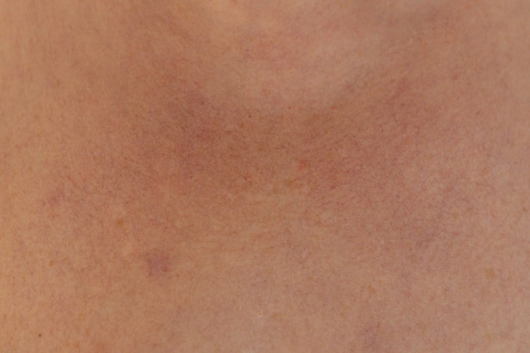 Photo Hyperpigmentation